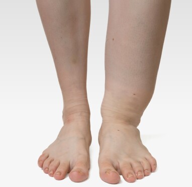 ENSIDIG HEVELSE: Ensidig hevelse er et vanlig symptom ved lymfødem. Foto: NTB Scanpix/Shutterstock ENSIDIG HEVELSE: Ensidig hevelse er et vanlig symptom ved lymfødem. Foto: NTB Scanpix/Shutterstock